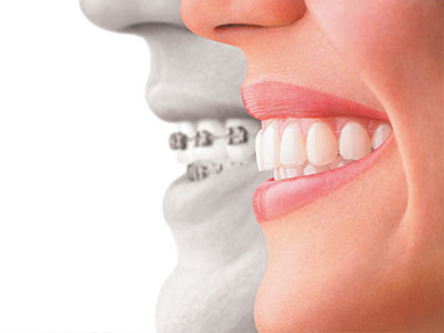 The image features a split-screen comparison of a person s mouth with teeth before and after dental treatment, likely highlighting the benefits of orthodontics.