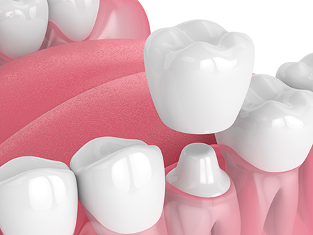 The image shows a collection of artificial teeth with varying shades of pink and white, arranged in a line against a white background.