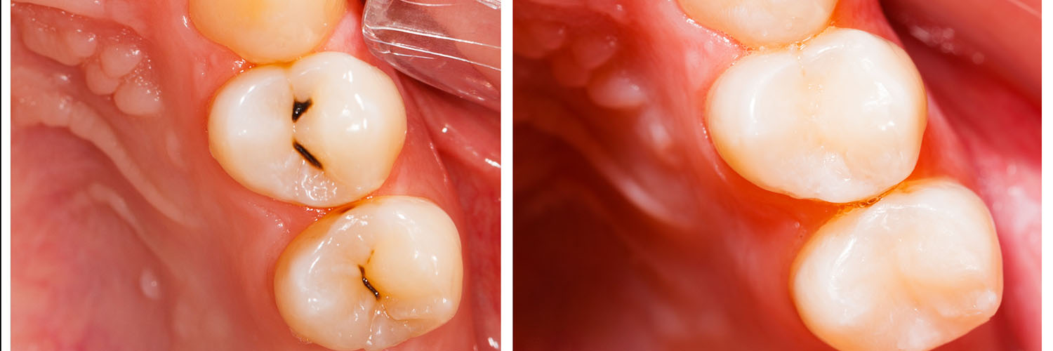 The image shows a close-up view of a dental implant with a metal post protruding from the gum, likely indicating a surgical procedure in progress or recently completed.