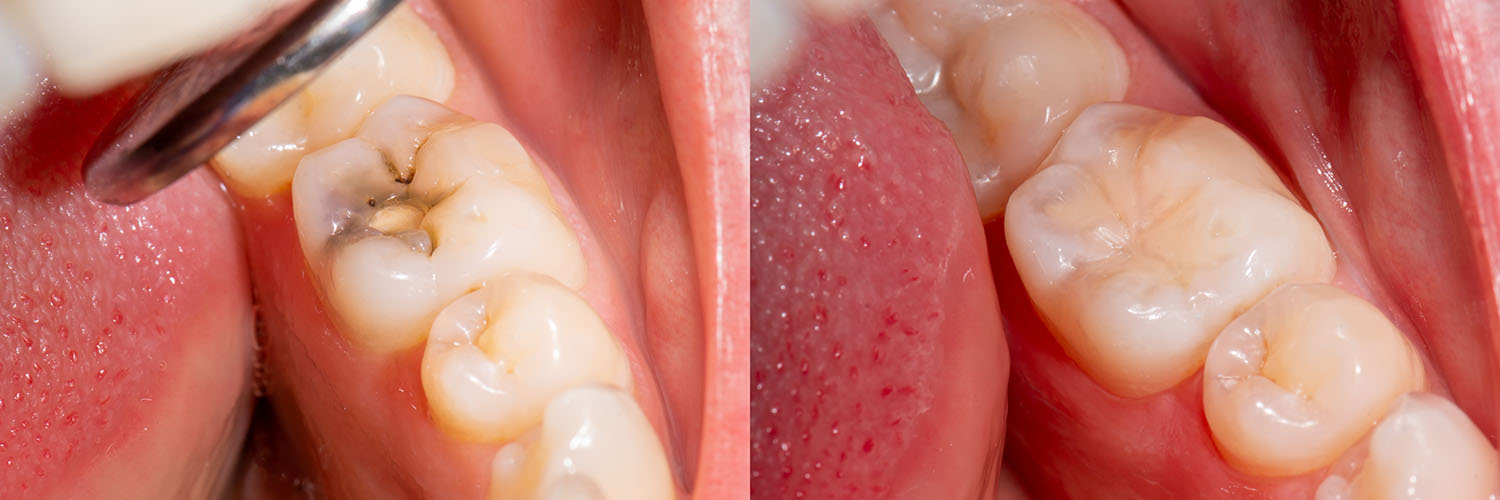 This is a close-up photograph of an open mouth with visible teeth, showing signs of decay and gum disease, possibly for dental educational purposes.